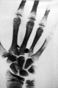Aufnahme der Hand eines 16j&auml;hrigen Patienten vom 29. Mai 1896 in Basel